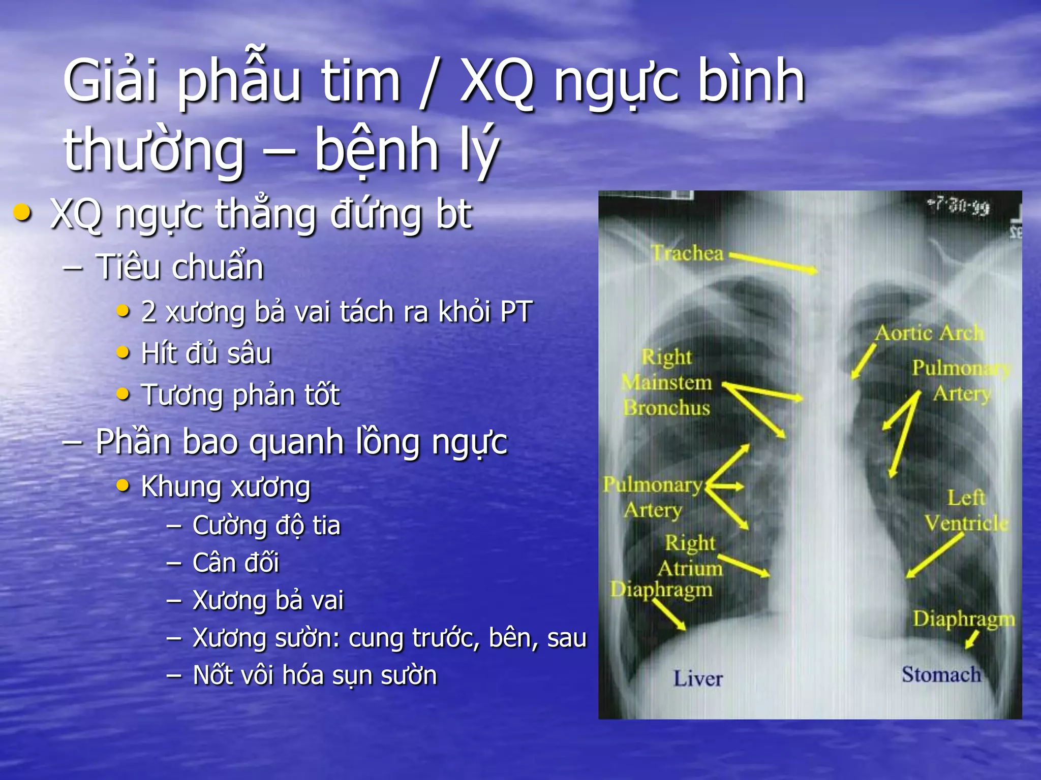 Giải phẫu tim / XQ ngực bình
thường – bệnh lý
• XQ ngực thẳng đứng bt
– Tiêu chuẩn
• 2 xương bả vai tách ra khỏi PT
• Hít đủ sâu
• Tương phản tốt
– Phần bao quanh lồng ngực
• Khung xương
– Cường độ tia
– Cân đối
– Xương bả vai
– Xương sườn: cung trước, bên, sau
– Nốt vôi hóa sụn sườn
 