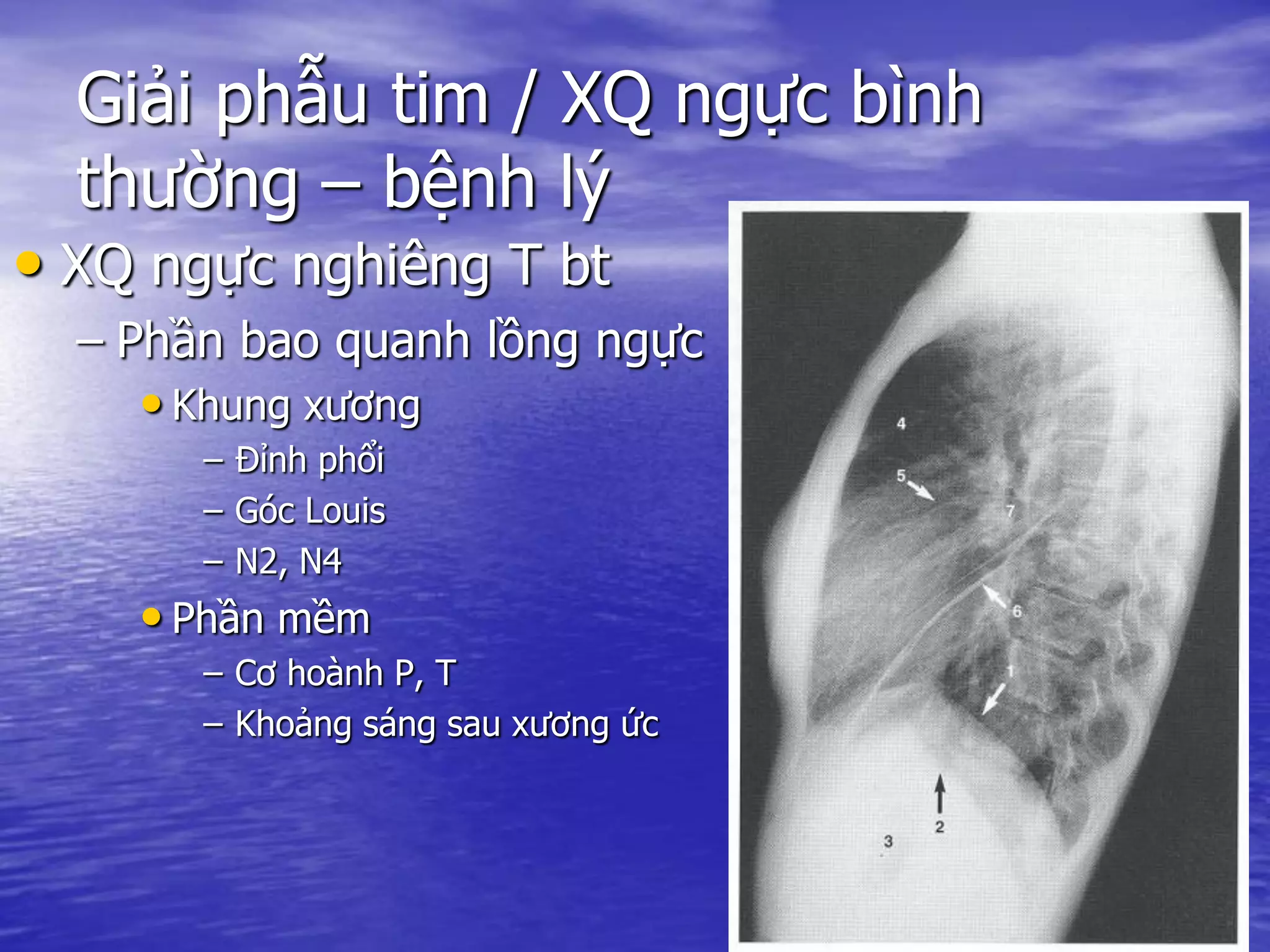 Giải phẫu tim / XQ ngực bình
thường – bệnh lý
• XQ ngực nghiêng T bt
– Phần bao quanh lồng ngực
• Khung xương
– Đỉnh phổi
– Góc Louis
– N2, N4
• Phần mềm
– Cơ hoành P, T
– Khoảng sáng sau xương ức
 
