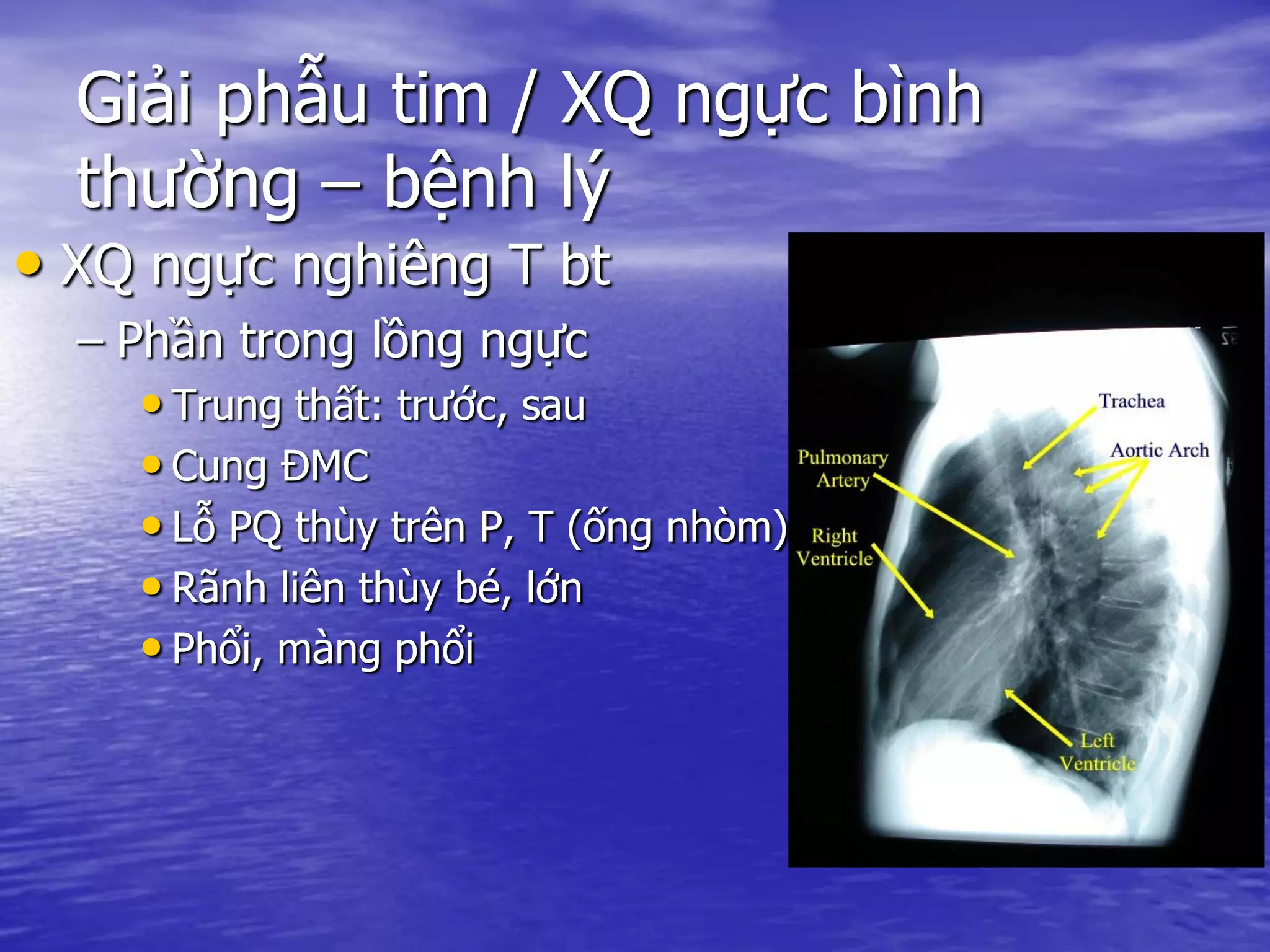 Giải phẫu tim / XQ ngực bình
thường – bệnh lý
• XQ ngực nghiêng T bt
– Phần trong lồng ngực
• Trung thất: trước, sau
• Cung ĐMC
• Lỗ PQ thùy trên P, T (ống nhòm)
• Rãnh liên thùy bé, lớn
• Phổi, màng phổi
 