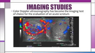 • Color Doppler ultrasonography has become the imaging test
of choice for the evaluation of an acute scrotum.
IMAGING STUDIES
 