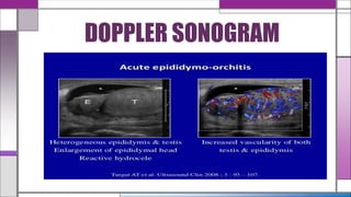 DOPPLER SONOGRAM
 