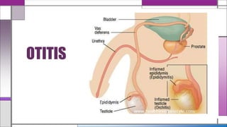 OTITIS
 