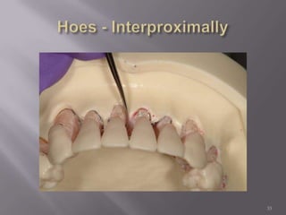 33Hoes - Interproximally