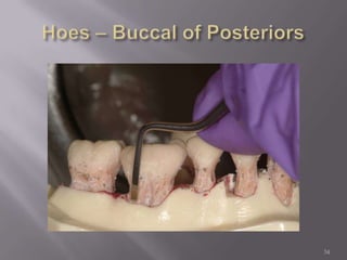 34Hoes – Buccal of Posteriors