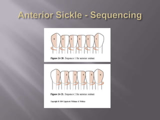 Anterior Sickle - Sequencing