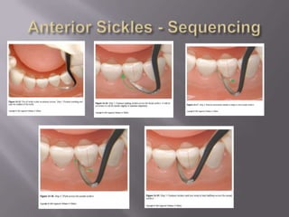 Anterior Sickles - Sequencing