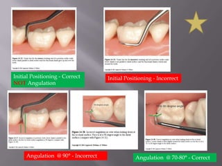 Initial Positioning - Correct NOT AngulationInitial Positioning - IncorrectAngulation  @ 90° - IncorrectAngulation  @ 70-80° - Correct