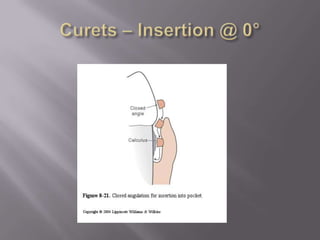 Curets – Insertion @ 0°