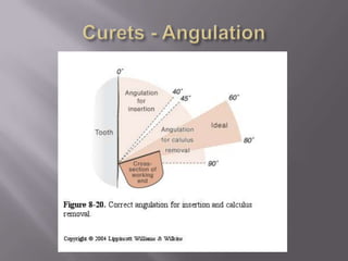 Curets - Angulation