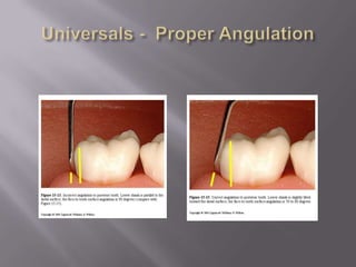 Use only 1-2 mm of toe on line anglesCurets - ApplicationsCuret Selection – Used for fine scaling & SRPUniversals – Used sub-gingivally Lt. to Mod depositsAreas-specifics – Used sub-gingivally Lt. depositsDesignSlender, moderately flexible shank = allows easy pocket access w/ minimal traumaCurved blade = rounded end permits access to base of pocketRounded back = minimizes trauma at base of pocketStrokePull stoke only (Vertical, horizontal, or oblique)