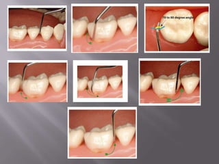 Universals -  Proper Angulation