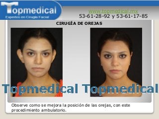 www.topmedical.mx
53-61-28-92 y 53-61-17-85
Observe como se mejora la posición de las orejas, con este
procedimiento ambulatorio.
CIRUGÍA DE OREJAS
 