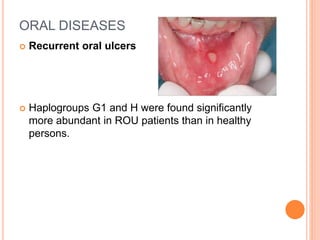 ORAL DISEASES
 Recurrent oral ulcers
 Haplogroups G1 and H were found significantly
more abundant in ROU patients than in healthy
persons.
 