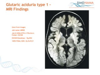 Glutaric aciduria type 1 –  MRI Findings (text from image) Job name: MRDD Job #:4906-079-6 175LnScrn Folder: H2/H8 05/069/Goodman – fig #04 100% FINAL SIZE: 26,9x35,9 
