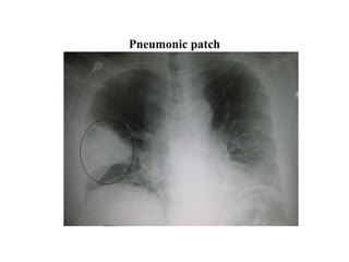 Pneumonic patch
 