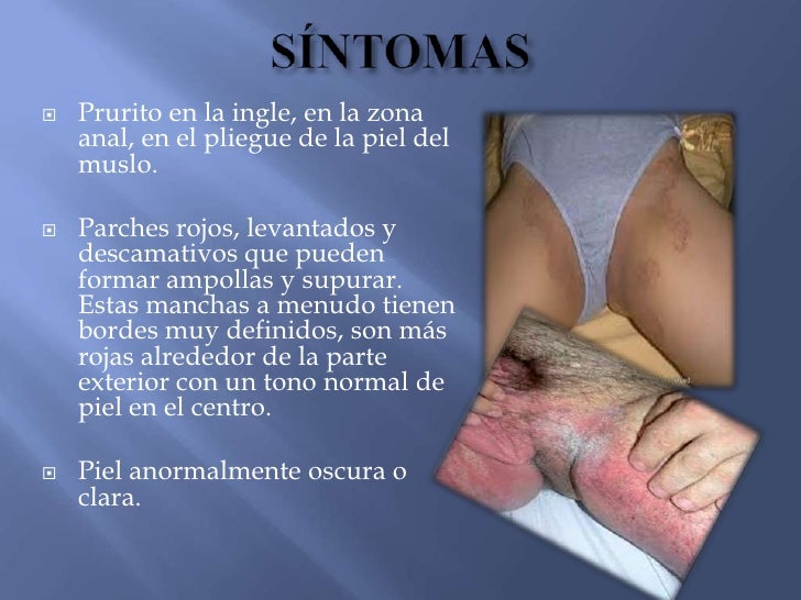 Si no curar la psoriasis de las uñas