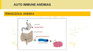 AUTO IMMUNE ANEMIAS
PERNICIOUS ANEMIA
 