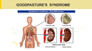 GOODPASTURE’S SYNDROME
 