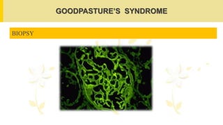GOODPASTURE’S SYNDROME
BIOPSY
 