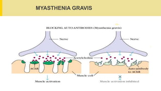 MYASTHENIA GRAVIS
 