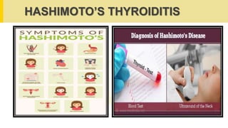 HASHIMOTO’S THYROIDITIS
 
