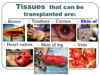 Tissues that can be 
transplanted are: 
 Bones  Tendons  Cornea 
 Skin of 
face 
 Heart valves  Skin of leg  Vein 
 