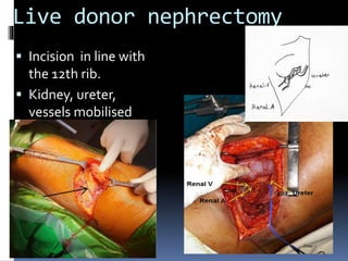 Live donor nephrectomy
 Incision in line with
the 12th rib.
 Kidney, ureter,
vessels mobilised
 