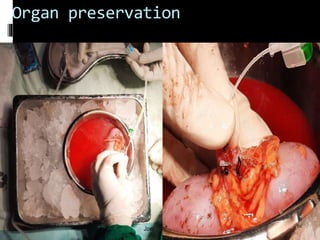 Organ preservation
 