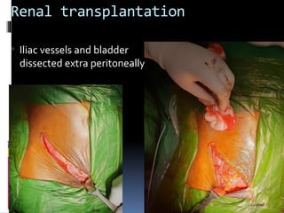 Renal transplantation
• Iliac vessels and bladder
dissected extra peritoneally’
 