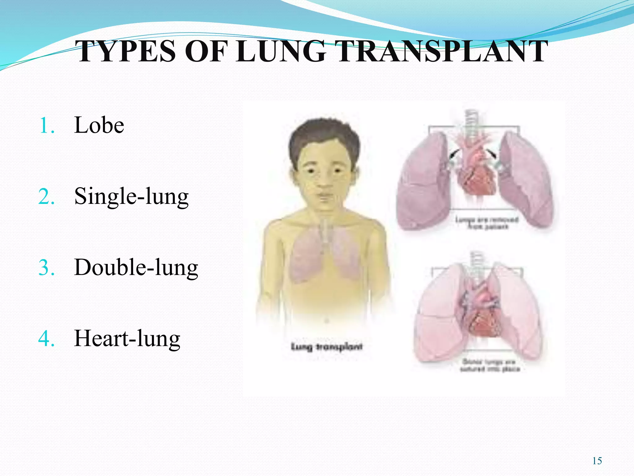 TYPES OF LUNG TRANSPLANT
1. Lobe
2. Single-lung
3. Double-lung
4. Heart-lung
15
 