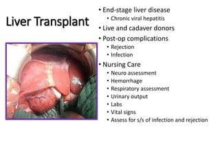 Liver Transplant
• End-stage liver disease
• Chronic viral hepatitis
• Live and cadaver donors
• Post-op complications
• Rejection
• Infection
• Nursing Care
• Neuro assessment
• Hemorrhage
• Respiratory assessment
• Urinary output
• Labs
• Vital signs
• Assess for s/s of infection and rejection
 