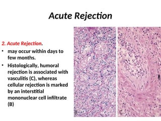 Comprehensive Overview of Organ Transplant Rejection and Immune ...