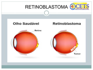 RETINOBLASTOMA
 