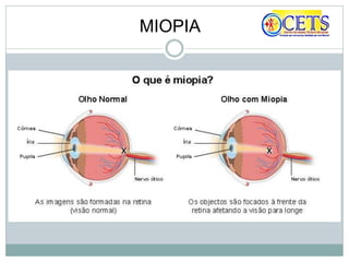 MIOPIA
 
