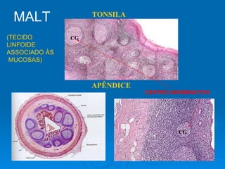 APÊNDICE CG CG TONSILA CENTRO GERMINATIVO MALT (TECIDO LINFOIDE ASSOCIADO ÀS MUCOSAS) 