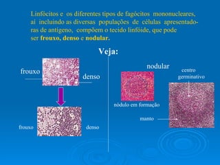 Linfócitos e  os diferentes tipos de fagócitos  mononucleares, aí  incluindo as diversas  populações  de  células  apresentado- ras de antígeno,  compõem o tecido linfóide, que pode ser  frouxo, denso  e  nodular. Veja: frouxo denso nodular nódulo em formação frouxo denso centro germinativo manto 