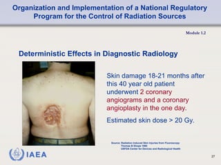 Organization and Implementation of a National Regulatory
Program for the Control of Radiation Sources
Module 1.2
27
Deterministic Effects in Diagnostic Radiology
Skin damage 18-21 months after
this 40 year old patient
underwent 2 coronary
angiograms and a coronary
angioplasty in the one day.
Estimated skin dose > 20 Gy.
Source: Radiation Induced Skin Injuries from Fluoroscopy
Thomas B Shope 1995
USFDA Center for Devices and Radiological Health
 