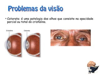 10
• Catarata: é uma patologia dos olhos que consiste na opacidade
parcial ou total do cristalino.
 