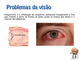 • Conjuntivite: é a inflamação da conjuntiva, membrana transparente e fina
que reveste a parte da frente do globo ocular (o branco dos olhos) e o
interior das pálpebras.
 