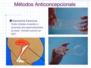 Métodos Anticoncepcionais
Camisinha Feminina:
Estes métodos impedem a
ascensão dos espermatozóides
ao útero. Também preveni as
DST.
 