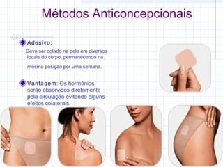 Métodos Anticoncepcionais
Adesivo:
Deve ser colado na pele em diversos
locais do corpo, permanecendo na
mesma posição por uma semana.
Vantagem: Os hormônios
serão absorvidos diretamente
pela circulação evitando alguns
efeitos colaterais.
 