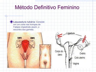 Método Definitivo Feminino
Laqueadura tubária: Consiste
em um corte nas trompas de
Falópio impedindo assim, o
encontro dos gameta.
 