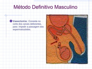 Método Definitivo Masculino
Vasectomia: Consiste no
corte dos canais deferentes,
para impedir a passagem dos
espermatozóides.
 