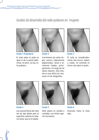 Orientaciones para la atención integral de salud del adolescente en el primer nivel de atención




                    Grados de desarrollo del vello pubiano en mujeres




                    Grado 1 Prepuberal                                      Grado 2                       Grado 3
                    El vello sobre el pubis es                              Crecimiento de vellos lar-    El vello es considerable-
                    igual al de la pared abdo-                              gos, suaves y ligeramente     mente más oscuro, áspero
                    minal, es decir, no hay ve-                             pigmentados, lacios o le-     y rizado. Se extiende en
                    llo pubiano.                                            vemente rizados, princi-      forma rala sobre el pubis.
                                                                            palmente a lo largo de los
                                                                            labios mayores. Este esta-
                                                                            dío es muy difícil de reco-
                                                                            nocer en las fotografías.




                    Grado 4                                                 Grado 5                       Grado 6
                    Las características del vello                           Vello adulto en calidad y     Extensión hasta la línea
                    son de tipo adulto pero la                              cantidad, con límite supe-    alba.
                    superficie	cubierta	es	toda-                            rior horizontal.
                    vía menor que en el adulto




 70
 