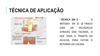 TÉCNICA DE APLICAÇÃO
• TÉCNICA EM Z O
MÉTODO EM Z (Z-TRACK)
CRIA UM ZIGUEZAGUE
ATRAVÉS DOS TECIDOS, O
QUE VEDA O TRAJETO DA
AGULHA, PARA EVITAR O
RETORNO DA VACINA.
 