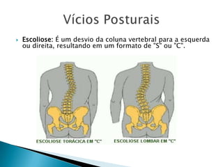 

Escoliose: É um desvio da coluna vertebral para a esquerda
ou direita, resultando em um formato de "S" ou "C".

 