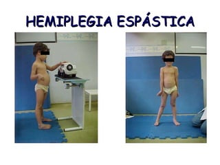 HEMIPLEGIA ESPÁSTICA 