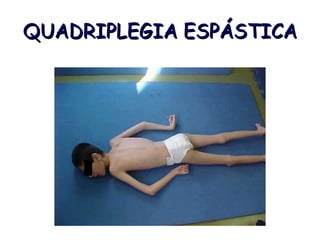 QUADRIPLEGIA ESPÁSTICA 