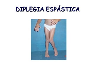 DIPLEGIA ESPÁSTICA 