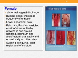 37
Female
 abnormal vaginal discharge
 Burning and/or increased
frequency of urination
 Lower abdominal pain
• Pain, itch, Papules, vesicles,
erosion/ulcers or fleshy
growths in and around
genitalia, perineum and
anus/rectum, oral cavity and
occasionally on other sites.
• Swelling in inguinal, anal
region and of scrotum.
 